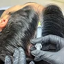 Intradermoterapia capilar