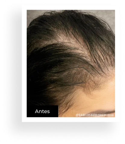 Antes — caso 2
