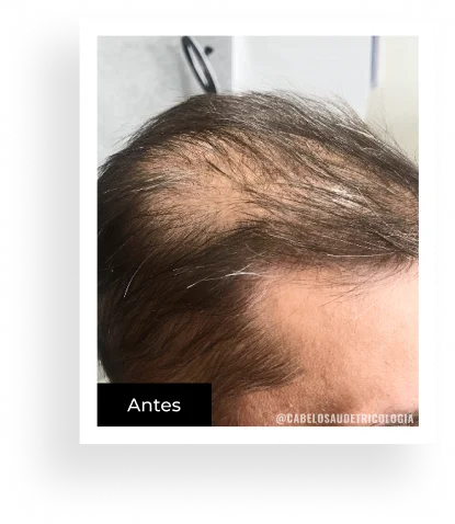Antes — caso 3