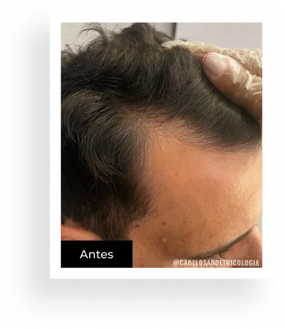 Antes — caso 4